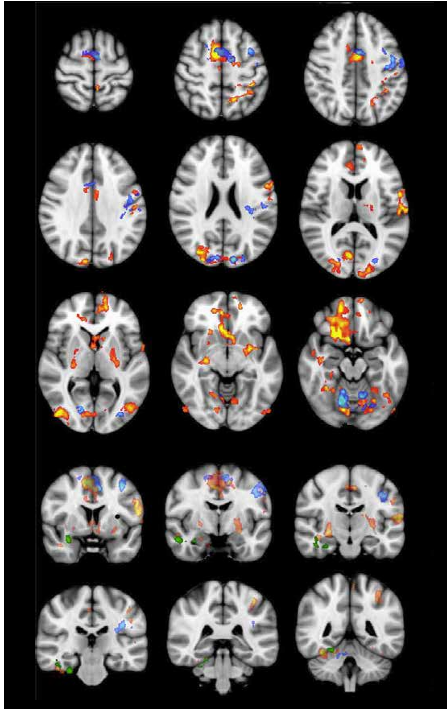 Forskning på Acem-meditasjon   - en oversikt